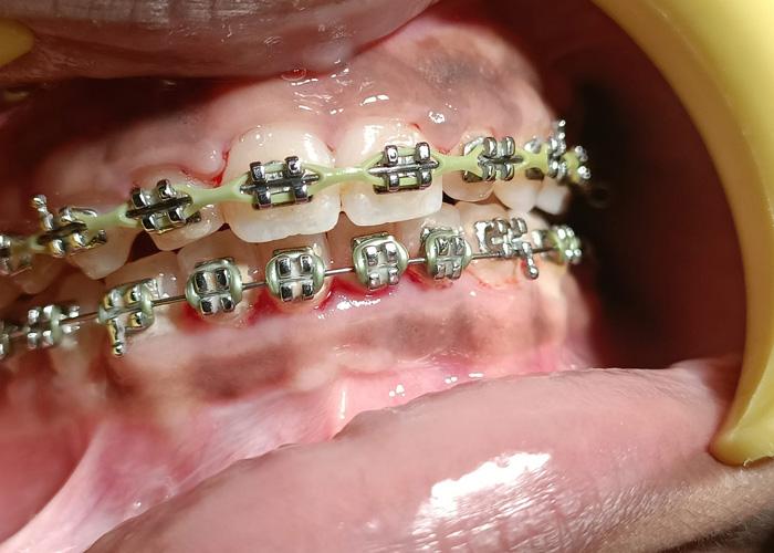 Metal Braces - Traditional Braces Cost - Kingston Orthodontics