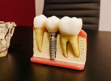 dental implant procedure