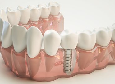 dental-implant-3d-model