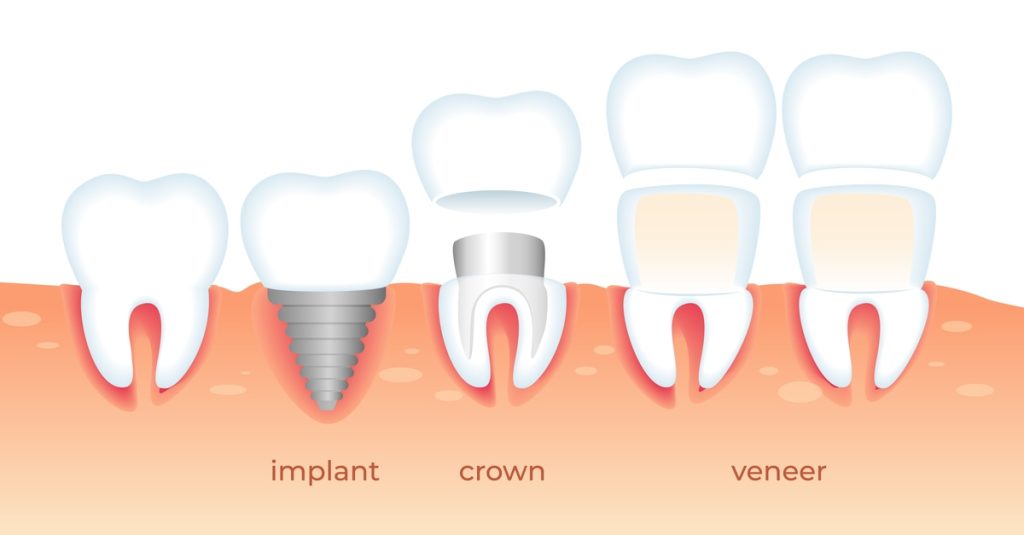 implant-veneer-crown
