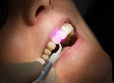Laser Root Canal