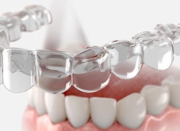 invisalign braces