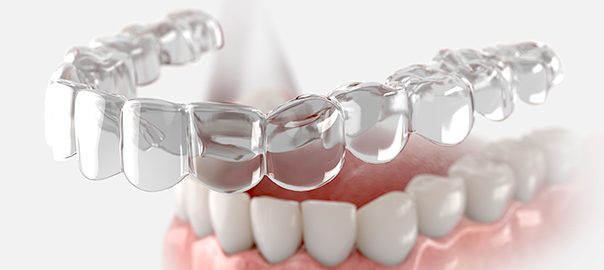 invisalign braces