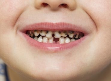 Tooth decay in kids