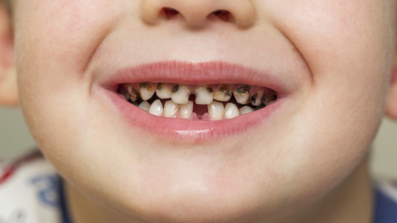 Tooth decay in kids