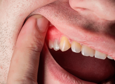 Gum Disease Treatment in Coimbatore