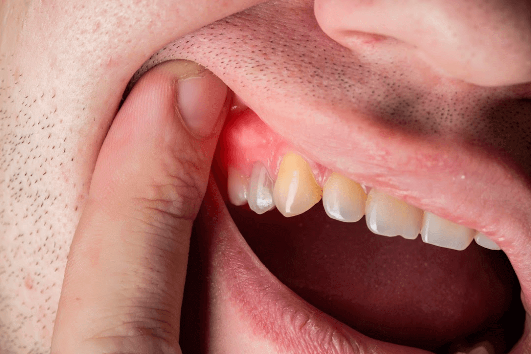 Gum Disease Treatment in Coimbatore